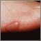 Keloid - on the foot
