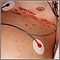 Herpes zoster (shingles) disseminated