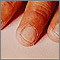 Kawasaki's disease - peeling of the fingertips