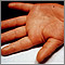 Kawasaki disease - edema of the hand