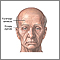 Forehead lift - series