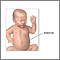Gastroschisis repair - series