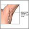 Swollen lymph nodes under arm