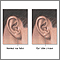 Ear lobe crease