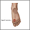 Kaposi sarcoma on foot