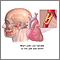 Jaw pain and heart attacks