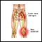 Sciatic nerve damage
