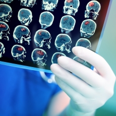 Acoustic Neuroma