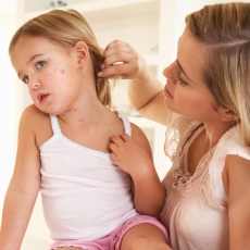 Chickenpox