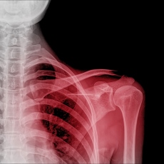 Dislocations