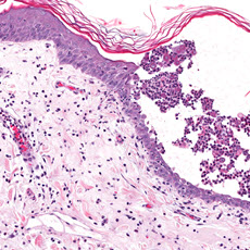 Pemphigus