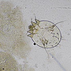 Scabies