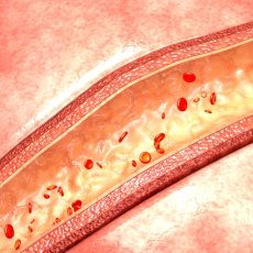 Vascular Diseases
