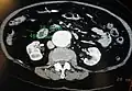 A transverse contrast enhanced CT scan demonstrating an abdominal aortic aneurysm of 4.8 by 3.8&nbsp;cm