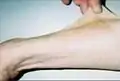Thirty-seven-year-old patient demonstrating hyperelasticity